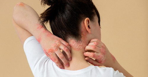 Adi's Libero Postherpetic Neuralgia Treatment